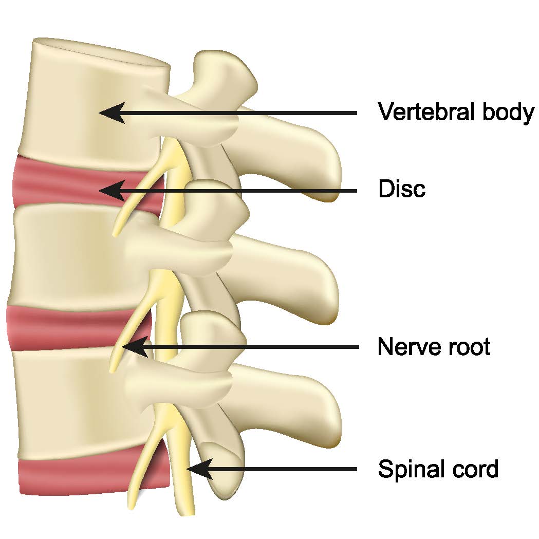 Must know information on spinal disc bulges, protrusions and sciatica!